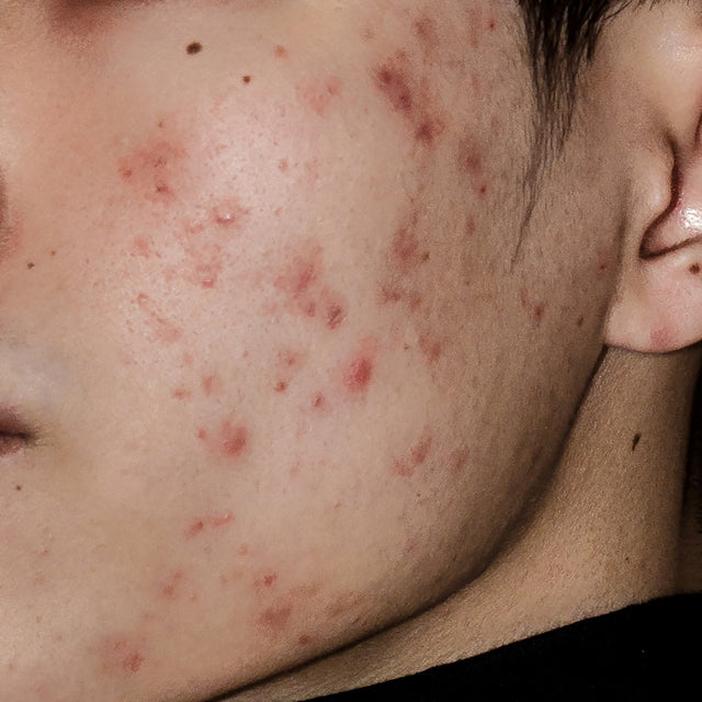 ACNE ADULTE : LES CAUSES NATURELLES A NE PAS NEGLIGER